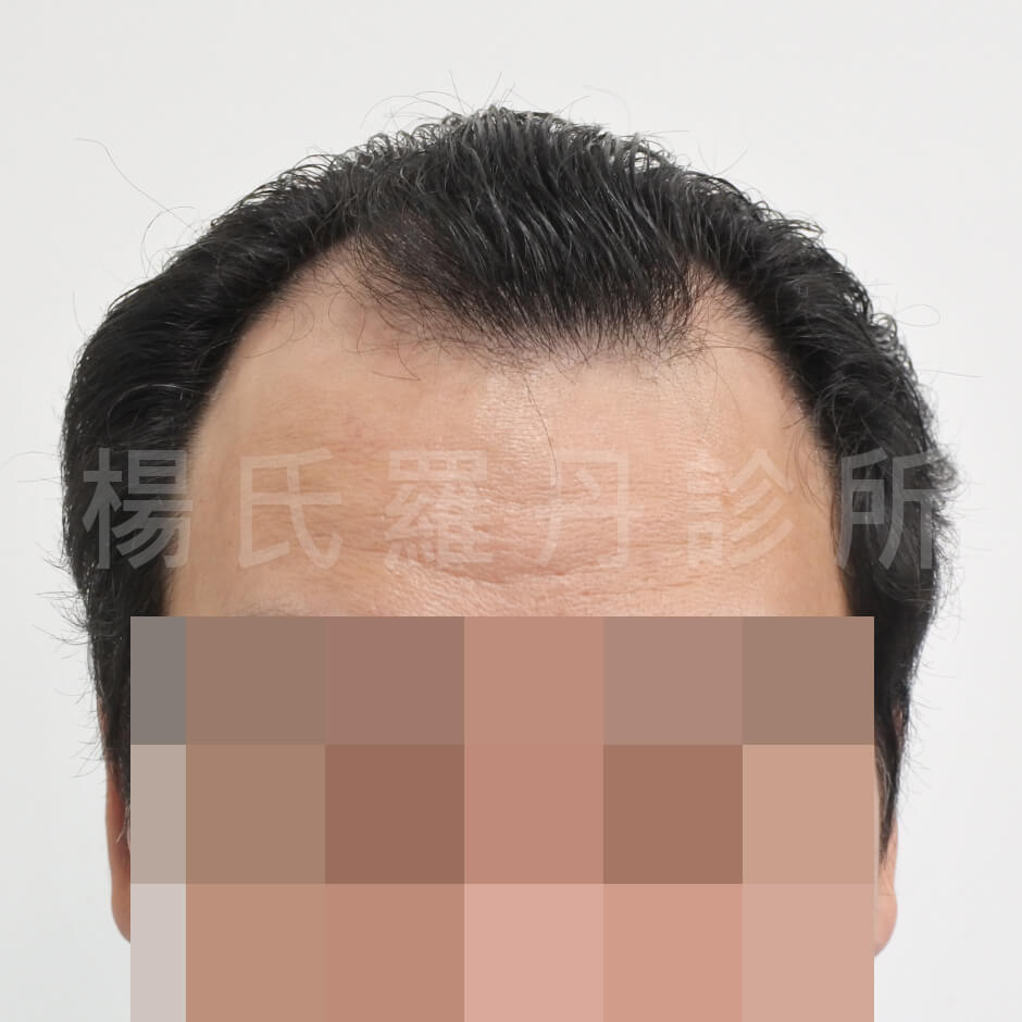 M型禿 植髮手術 禿頭 植髮